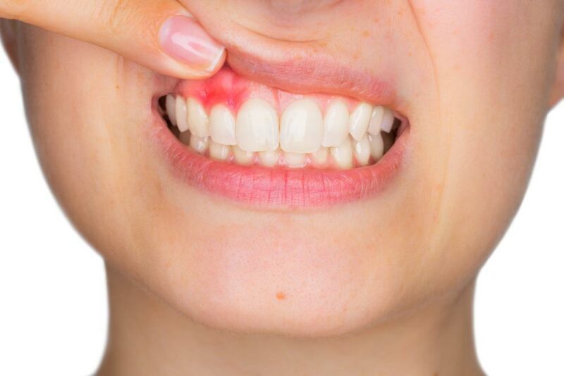 Swollen Gums Around The Tooth HR Family Dental Highlands Ranch CO